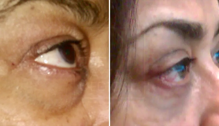 lower blepharoplasty before and after-2