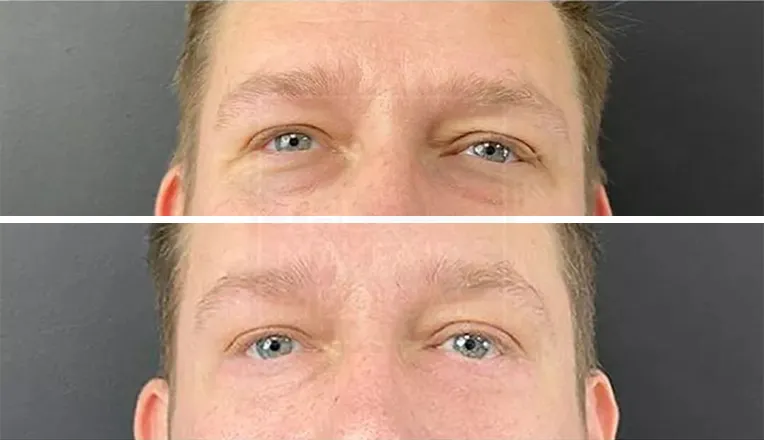 lower blepharoplasty before and after