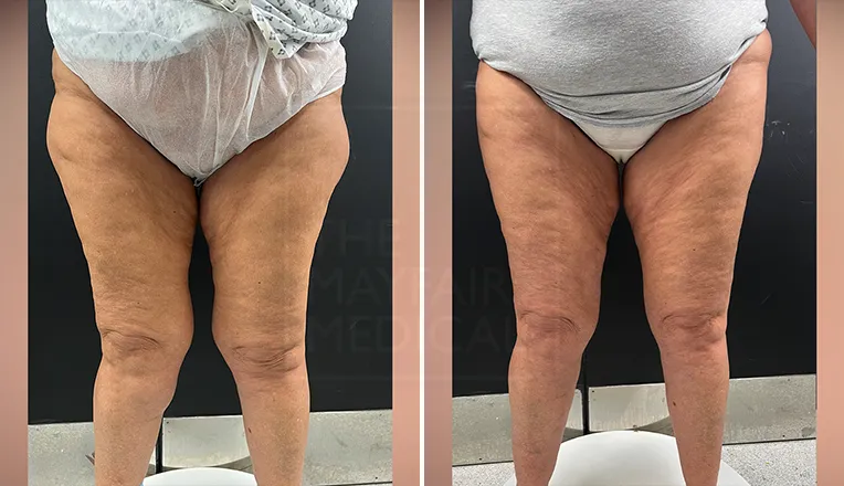 outer thigh liposuction before and after patient-2