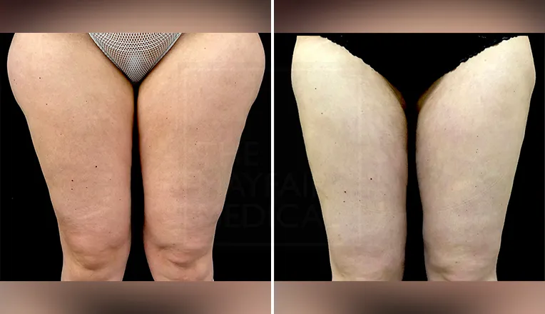 outer thigh liposuction before and after