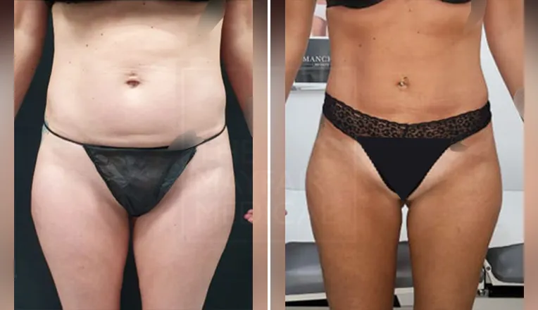 stomach liposuction before and after-1