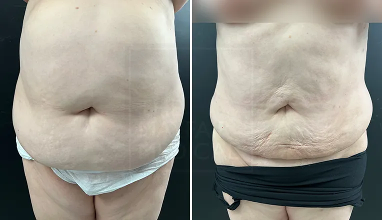 stomach liposuction before and after-2