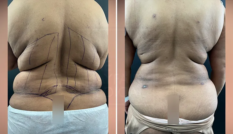 stomach liposuction before and after-3