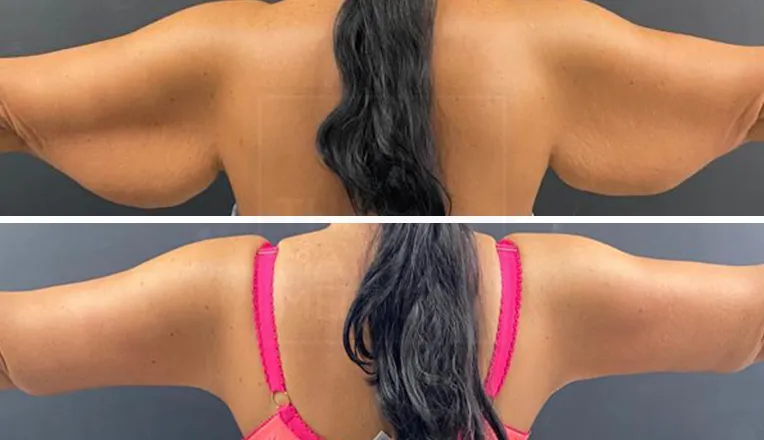 under arm liposuction before and after-1