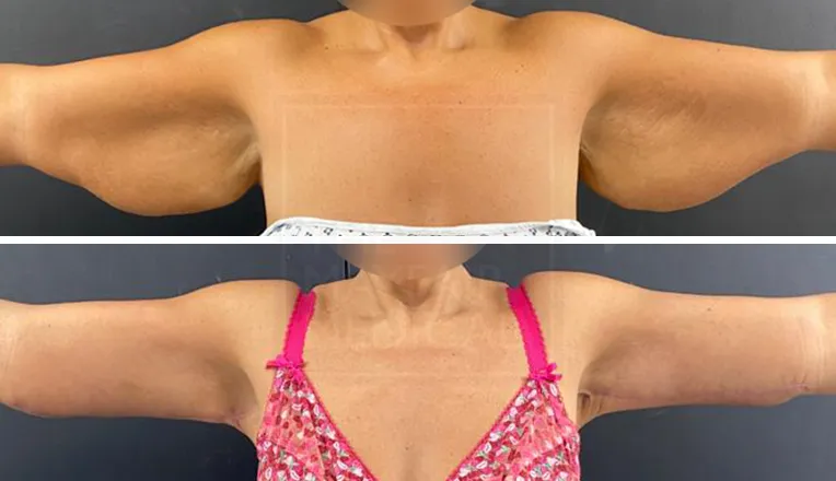 under arm liposuction before and after