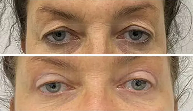 upper blepharoplasty before and after