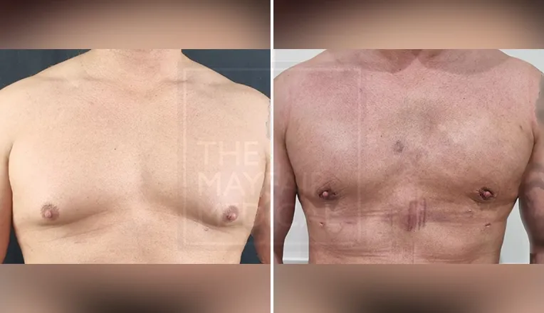 gynaecomastia before and after result
