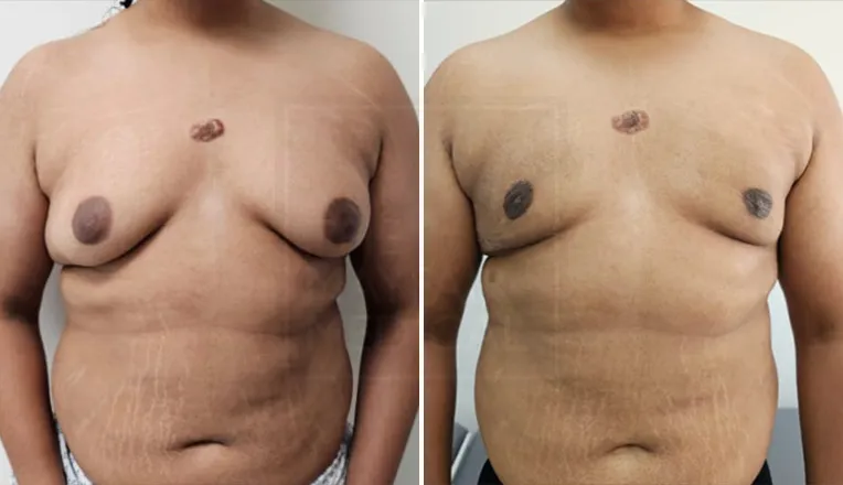 gynaecomastia before and after