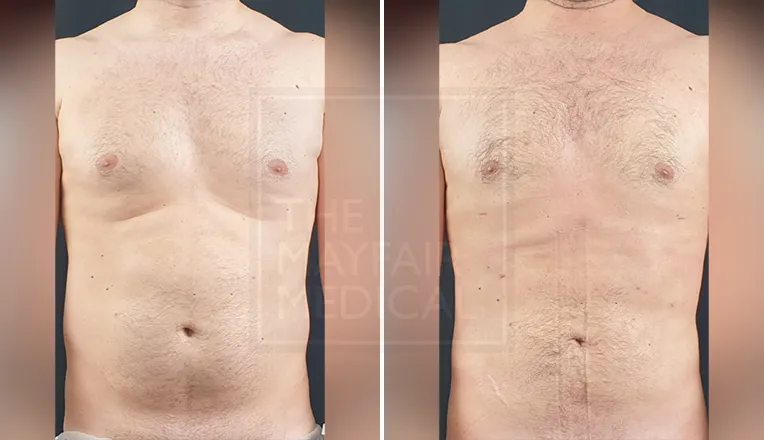 gynaecomastia surgery before and after