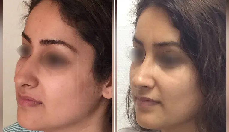 before and after rhinoplasty