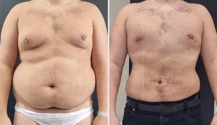 gynaecomastia before and after result