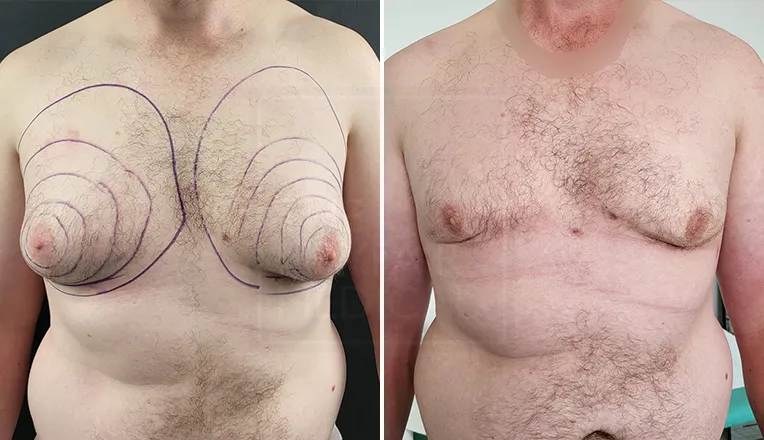 gynaecomastia before and after