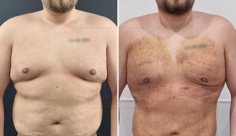 gynaecomastia patient before and after result