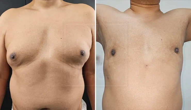 gynaecomastia surgery before and after result