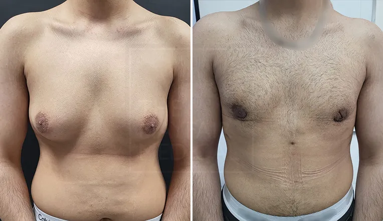 gynaecomastia surgery before and after