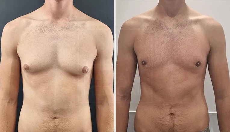 gynaecomastia treatment before and after