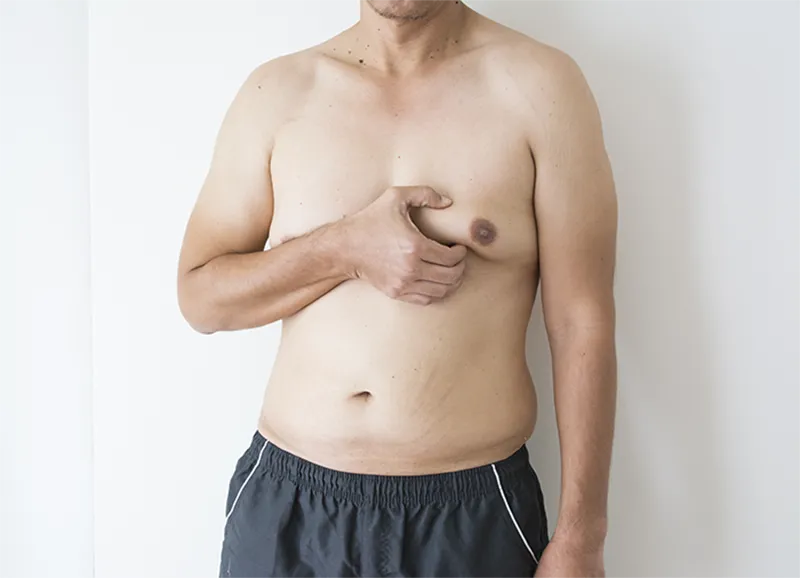 man with gynecomastia showing his breast