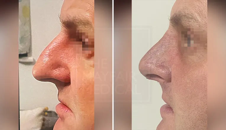 nose job before and after male