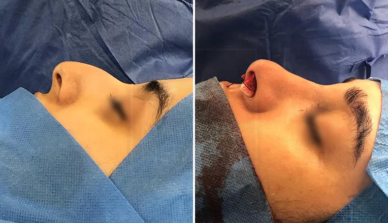 rhinoplasty before and after male-1