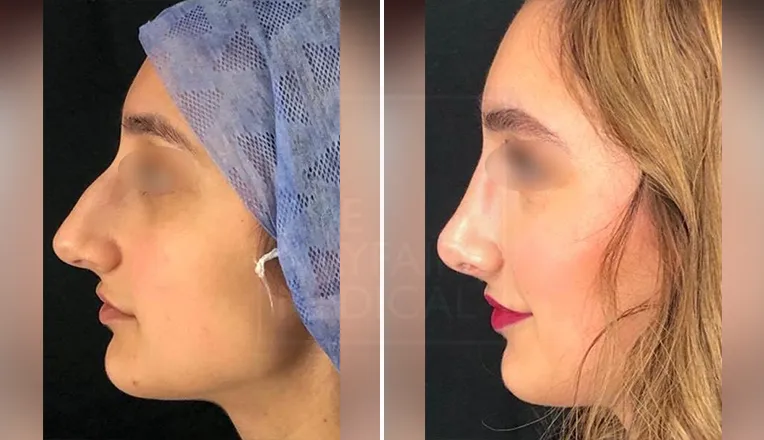 rhinoplasty before and after result