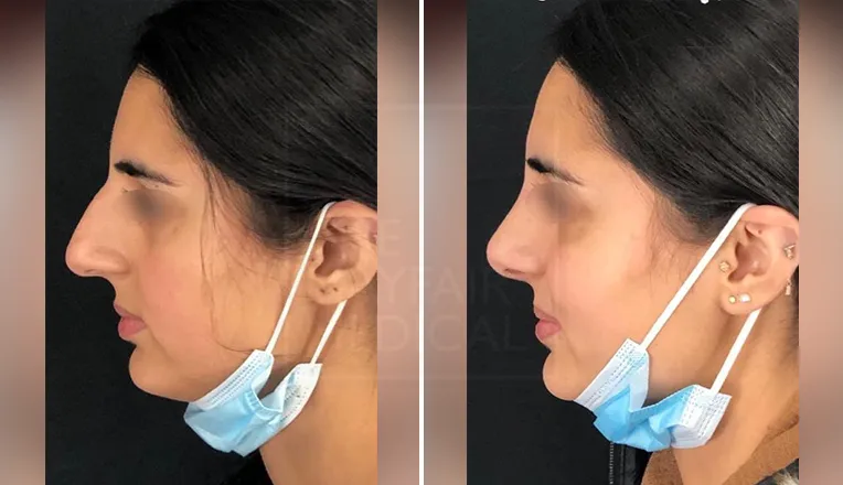 wide nose rhinoplasty before and after