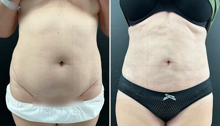 stomach vaser liposuction before and after-1