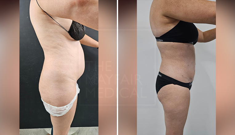 vaser liposuction female abs before and after result